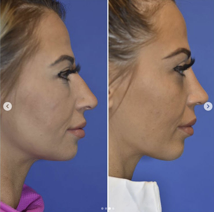 how much is rhinoplasty surgery